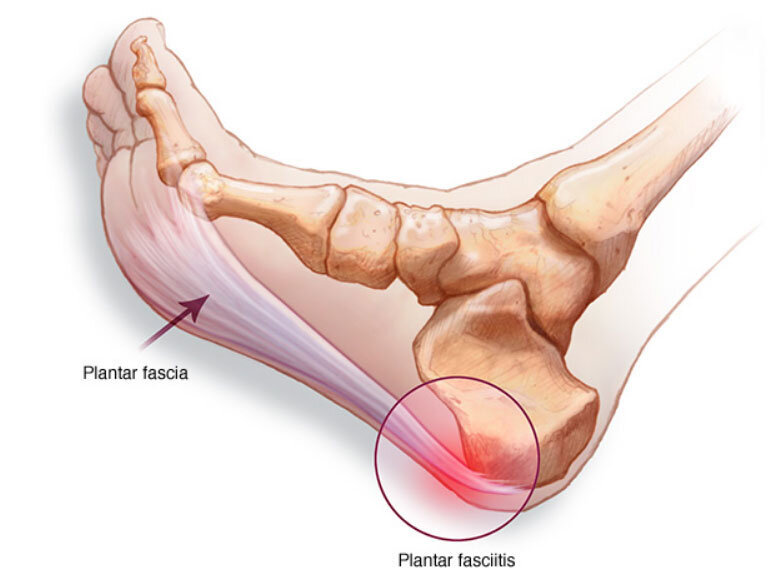 Topuk Dikeni (Plantar Fasiit)